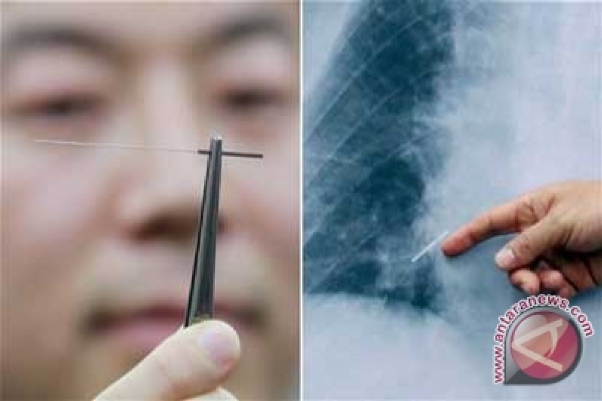 Acupuncture needle found in ex-s. Korea President`s lung