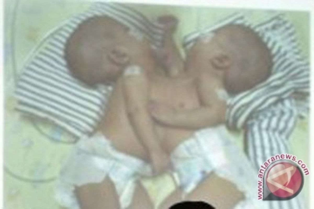 Bayi kembar siam Kirani-Kirana tak bisa dipisahkan 