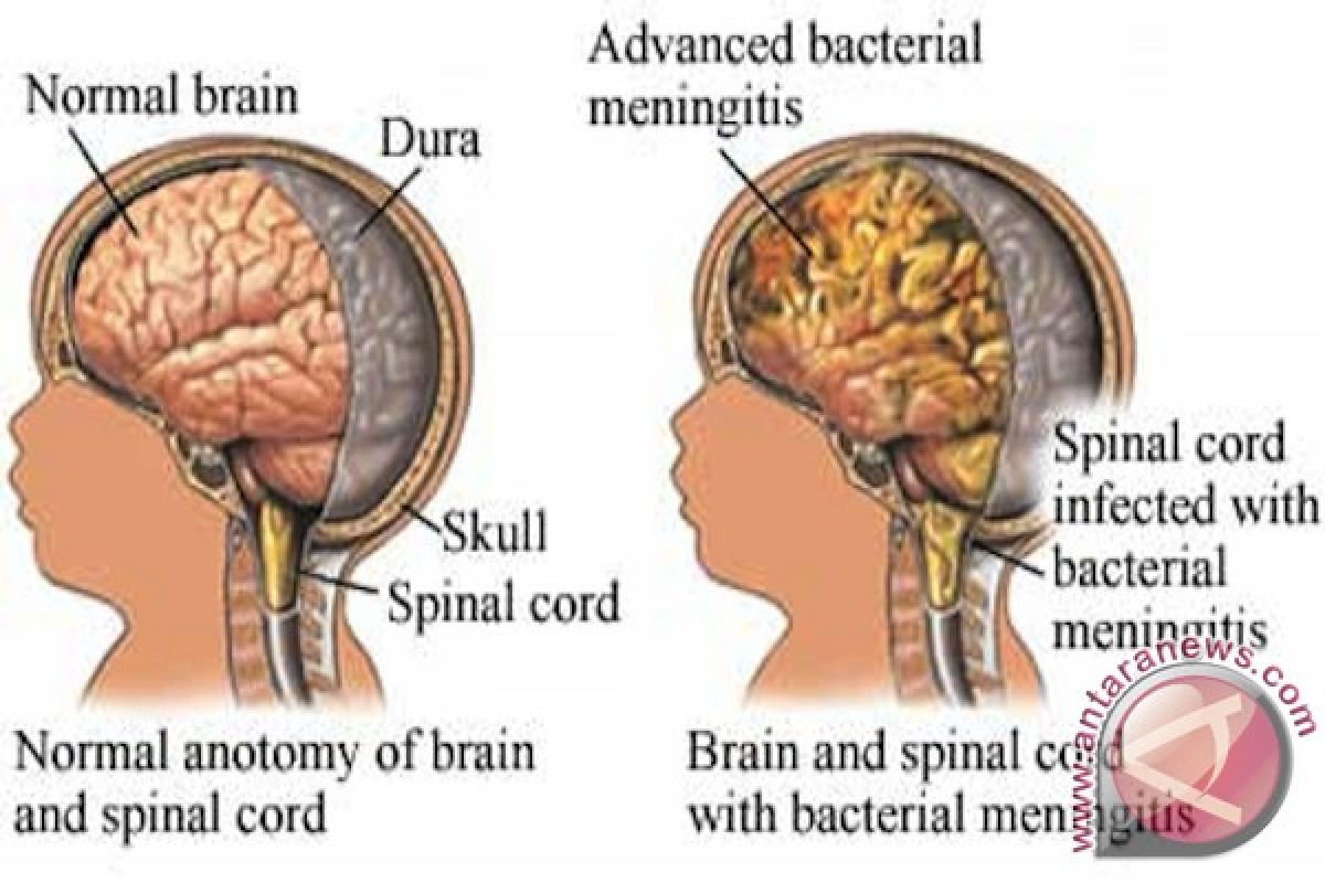 Dokter : Jangan sepelekan gejala meningitis