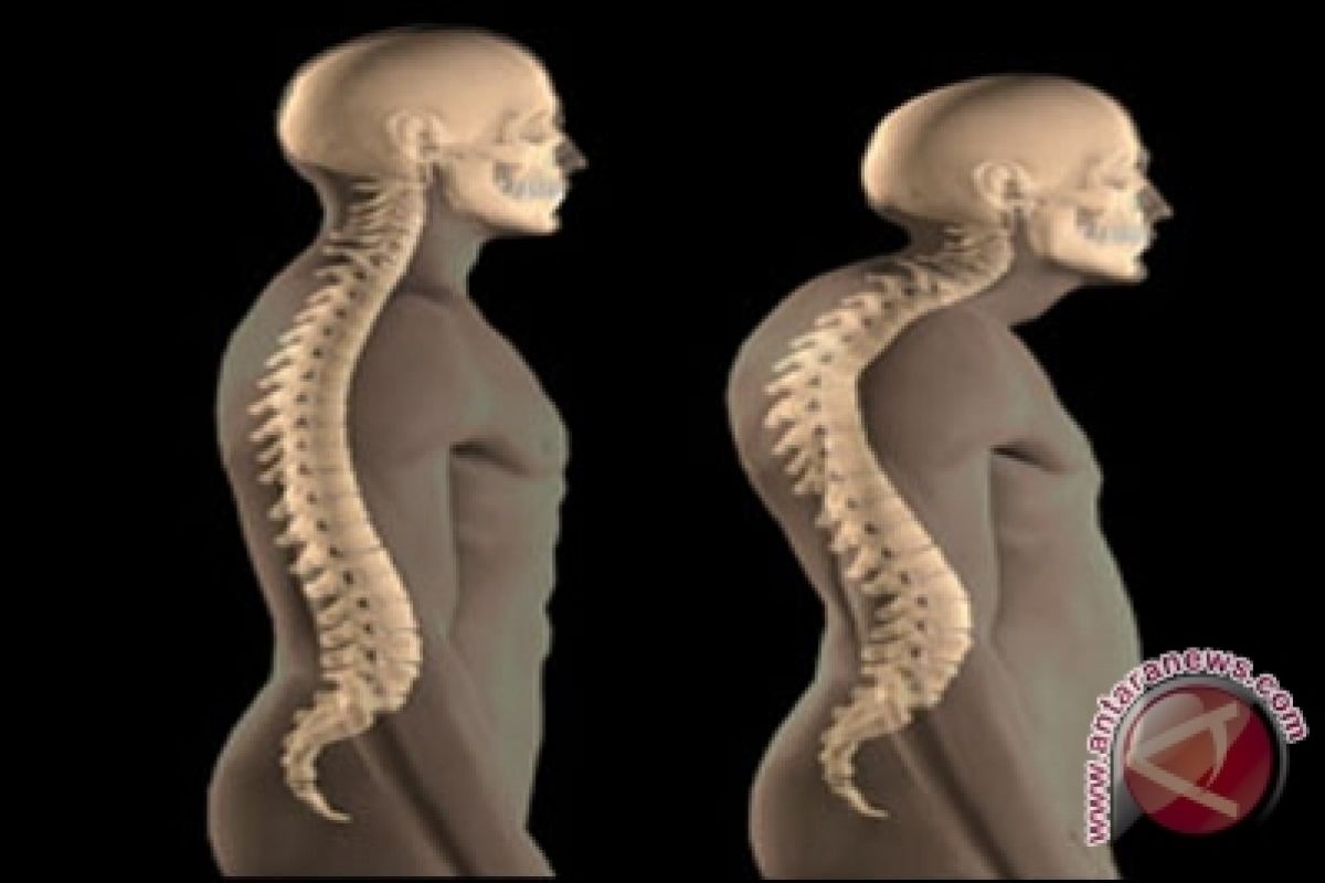 Diet berlebihan picu osteoporosis