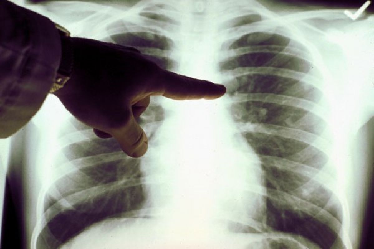 Early signs of lung cancer could be diagnosed by simple blood test