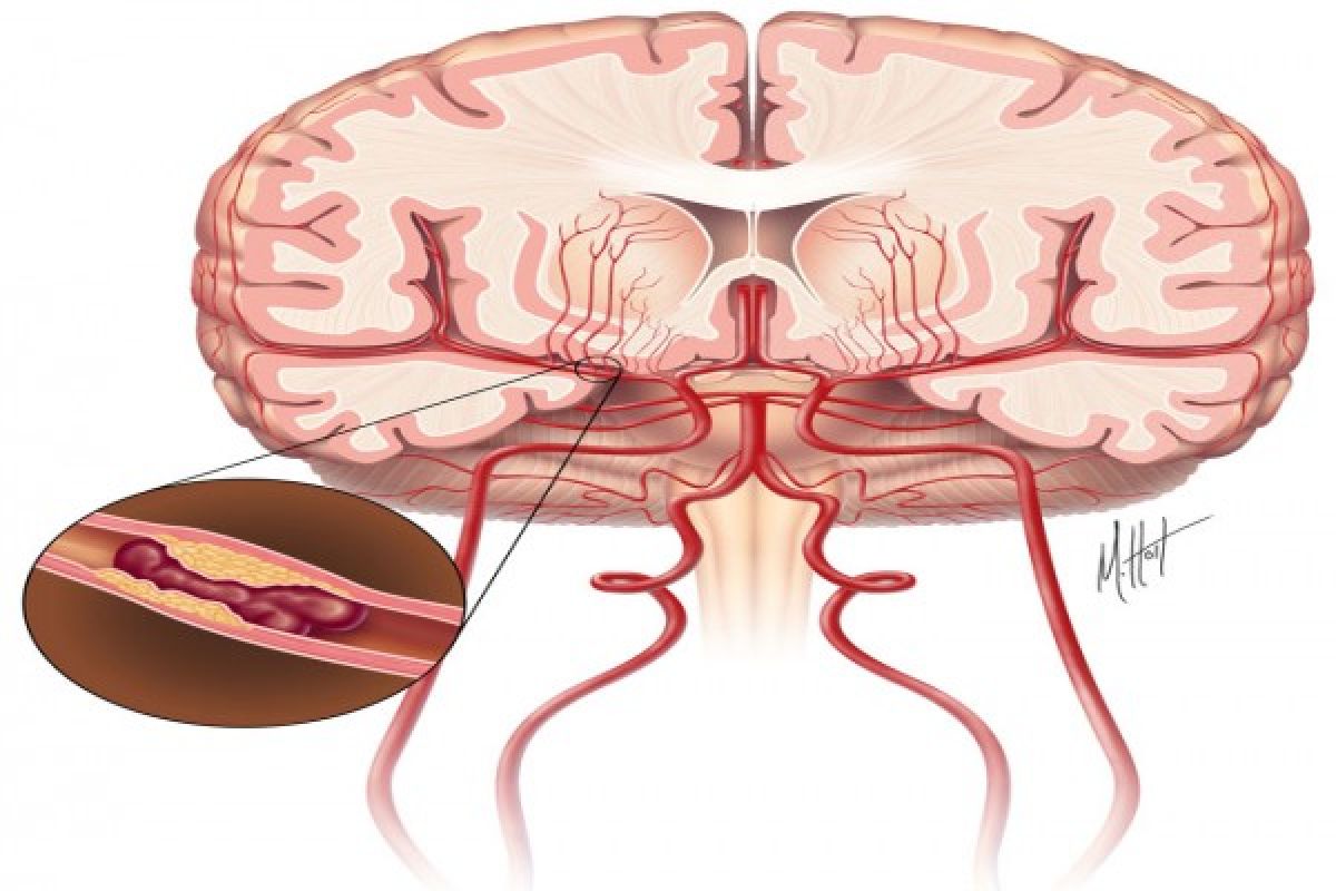 Pembuluh darah tersumbat penyebab tertinggi stroke