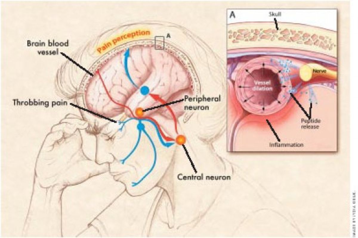 Nearby lighthing may be linked to migraines