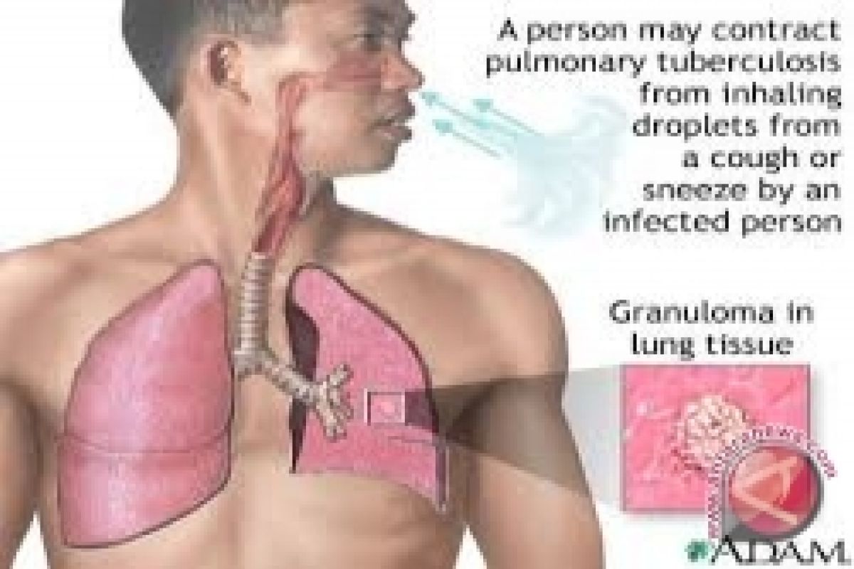 Kulon Progo lmbau masyarakat menghindari TB MDR