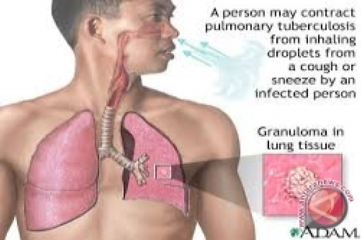 Yogyakarta siapkan rangkaian kegiatan peringatan Hari TB