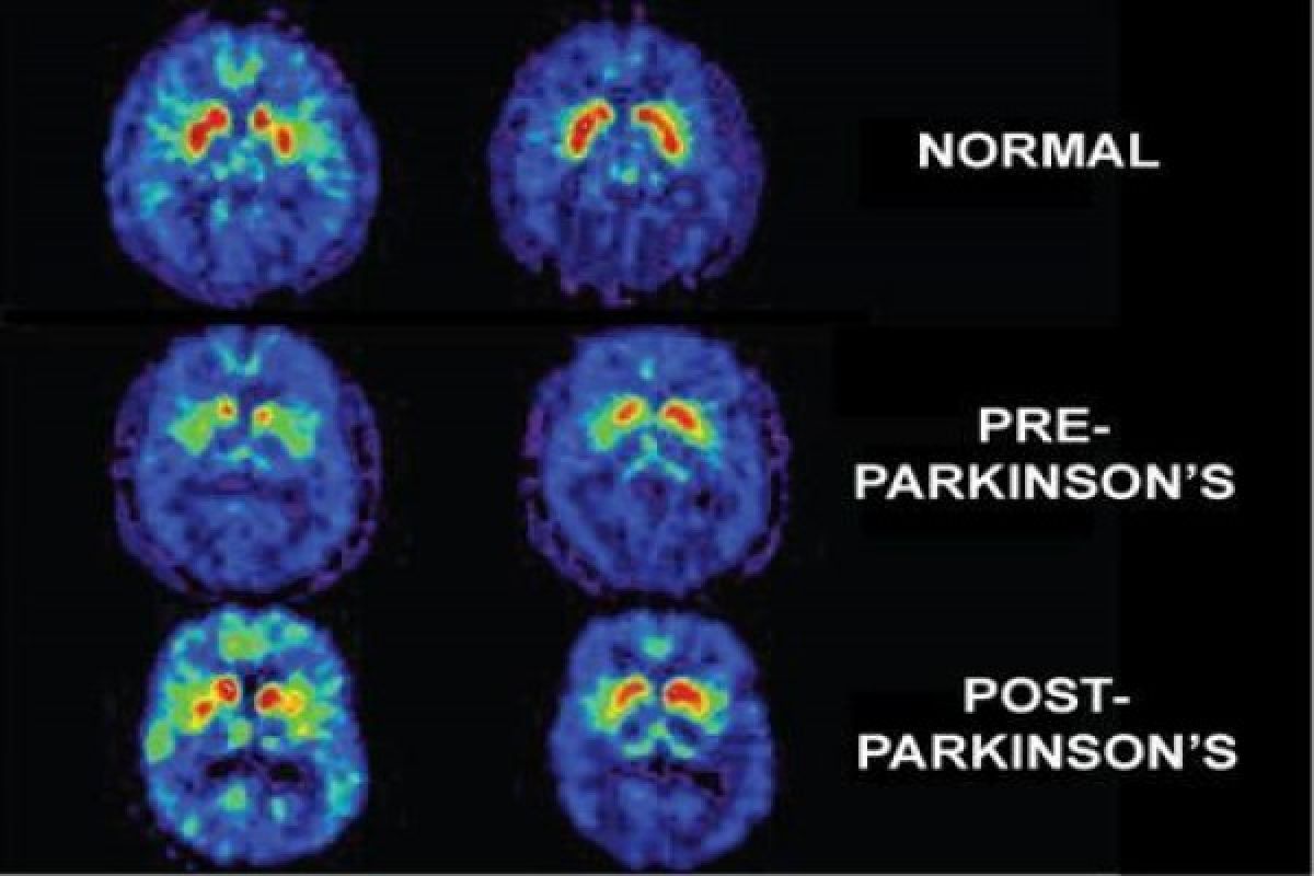 Intel kembangkan jam tangan pemantau Parkinson