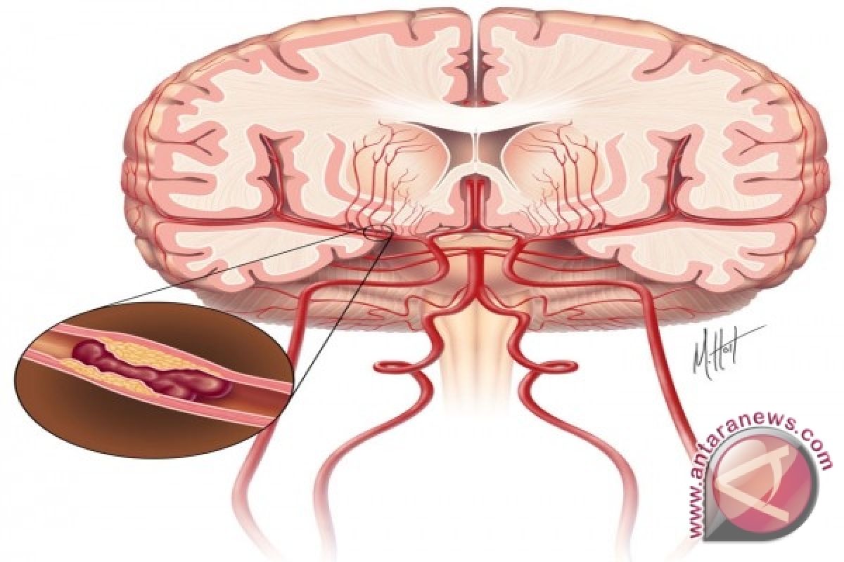 Benarkah stroke mengincar kaum muda?