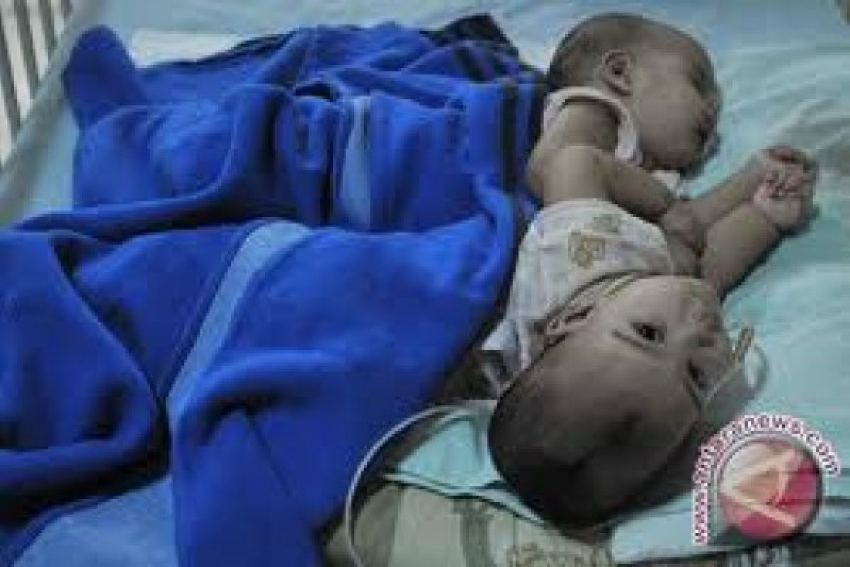 RSUP dr Kariadi Kembali Tangani Bayi Kembar Siam