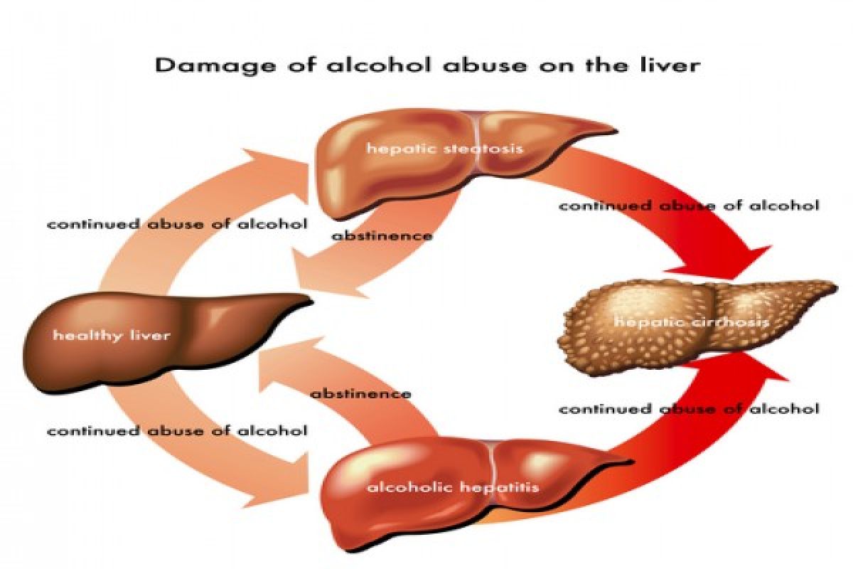 Scientists find way to prevent alcohol damage to liver