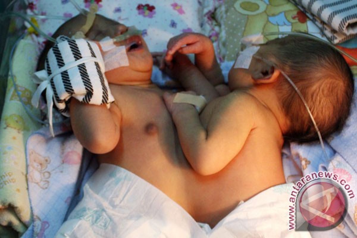 Operasi bayi kembar siam asal Banyuwangi berhasil