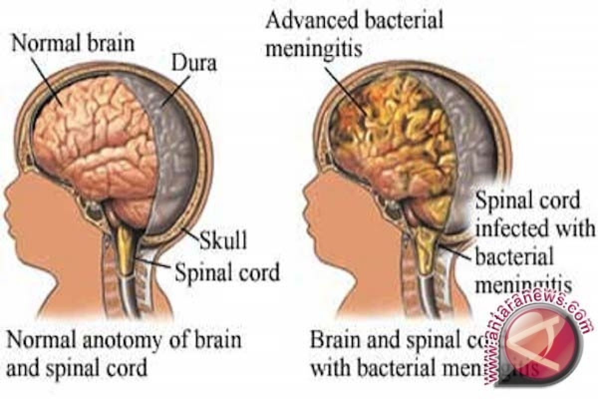 Dokter: Jangan sepelekan gejala meningitis, segera periksakan