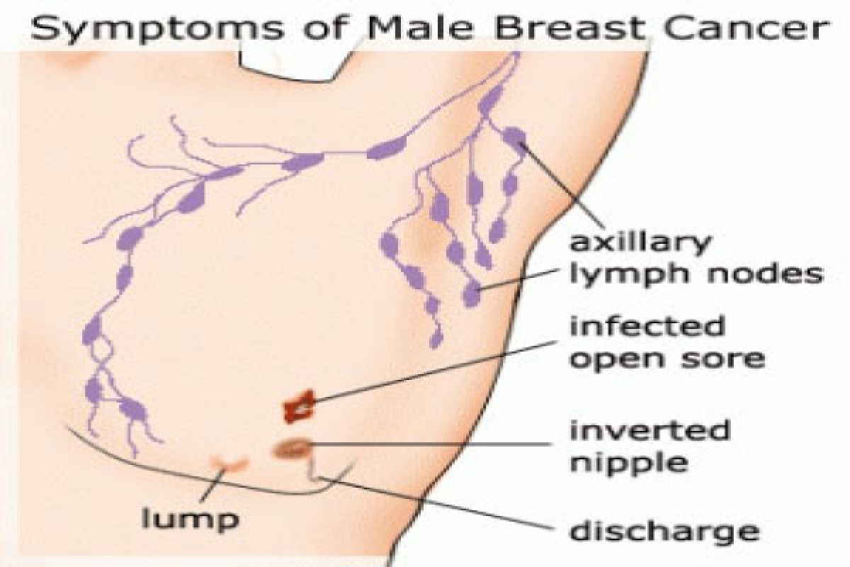 Kanker payudara pada laki-laki lebih ganas