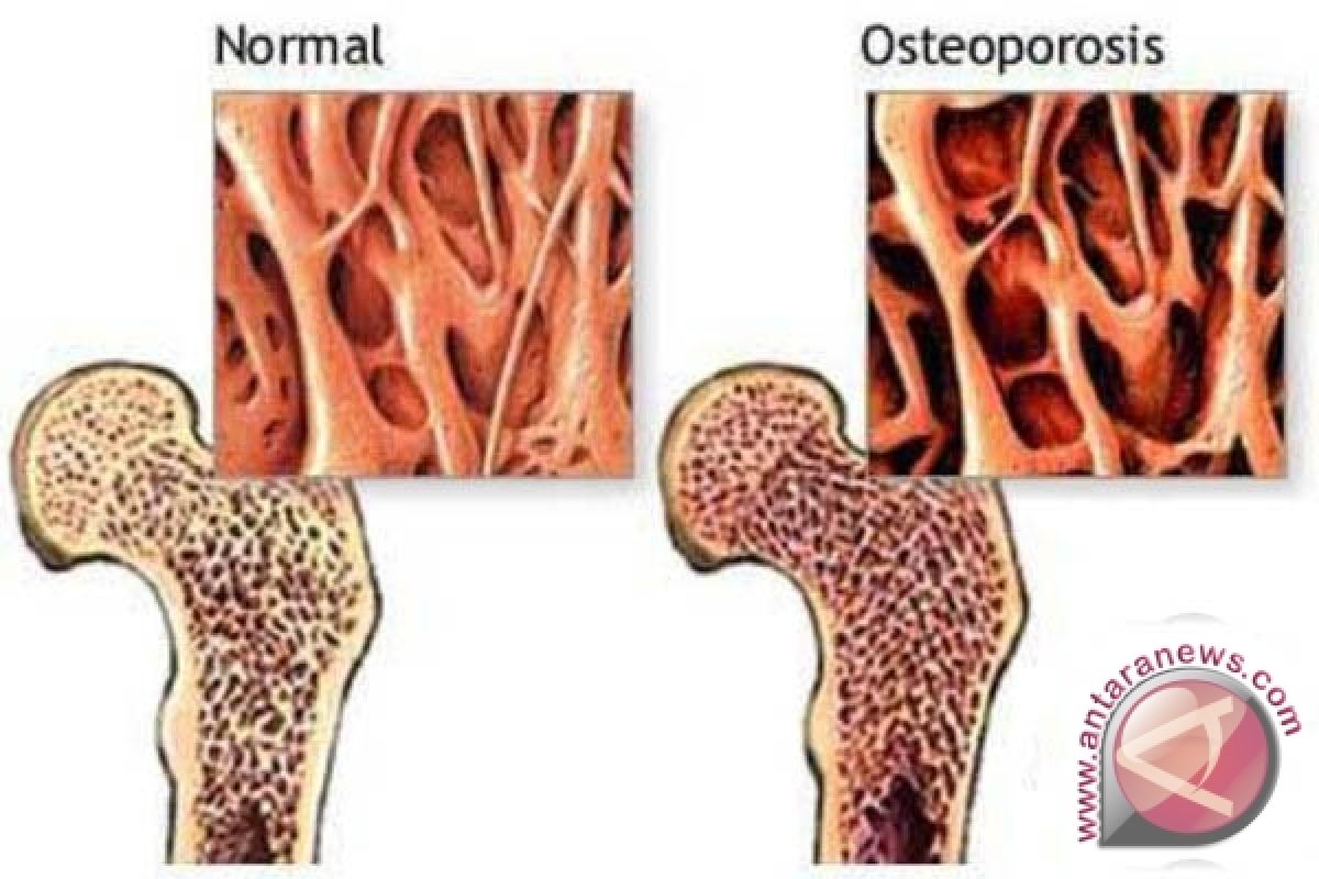 Efek Terusan Osteoporosis Sebabkan Infeksi Paru-paru.