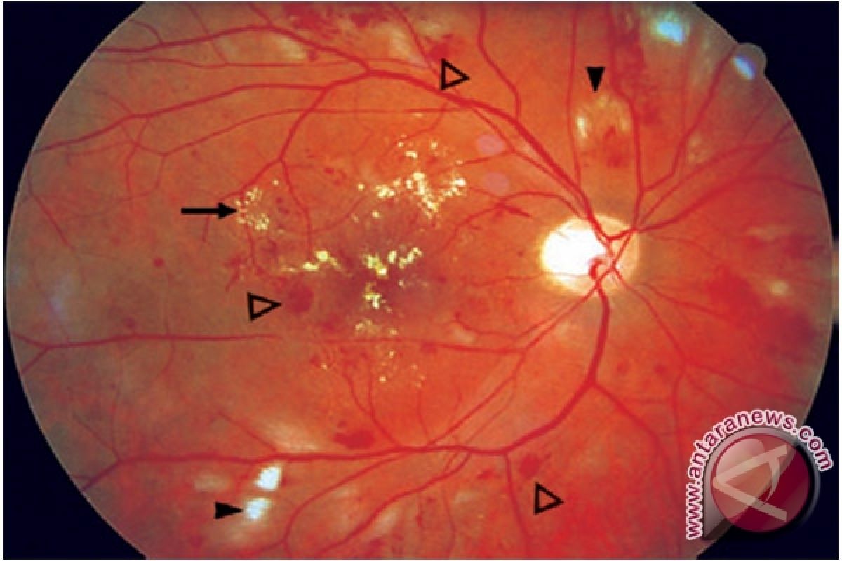 Penderita diabetes mellitus berisiko terkena retinopati diabetik 