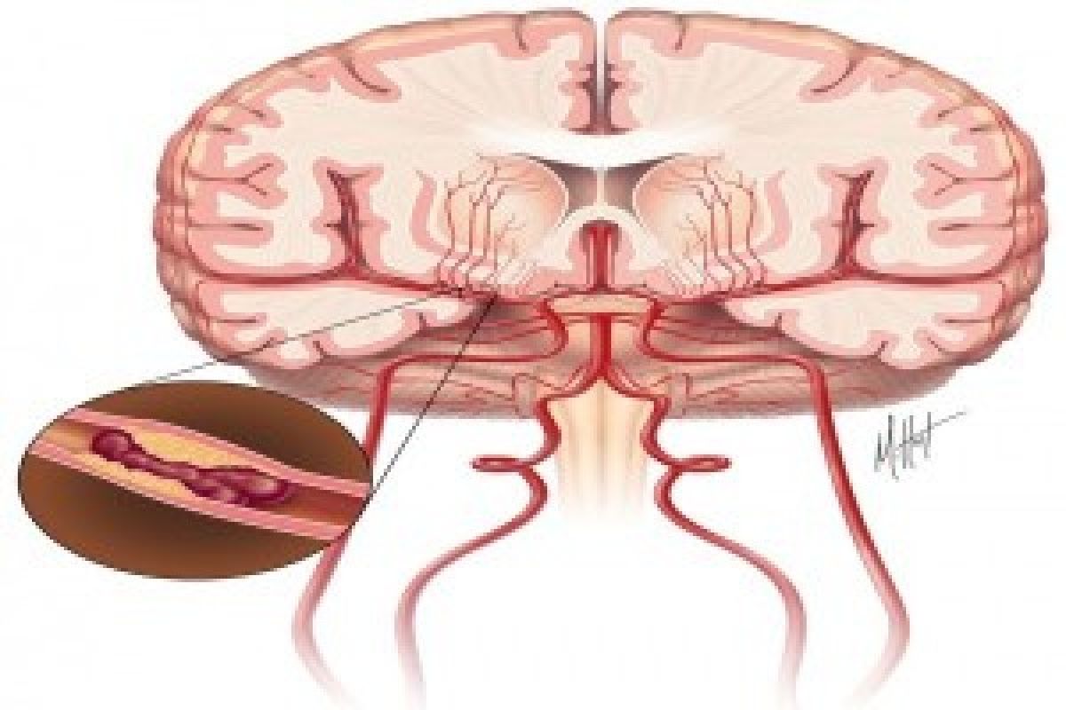 Stroke Bisa Datang Akibat Cemas