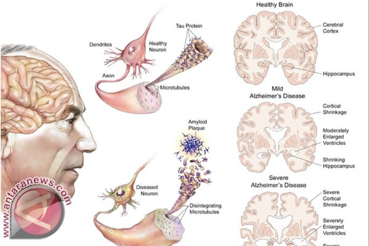 Ilmuwan Indonesia buktikan regenerasi sel otak jadi pengobatan alzheimer