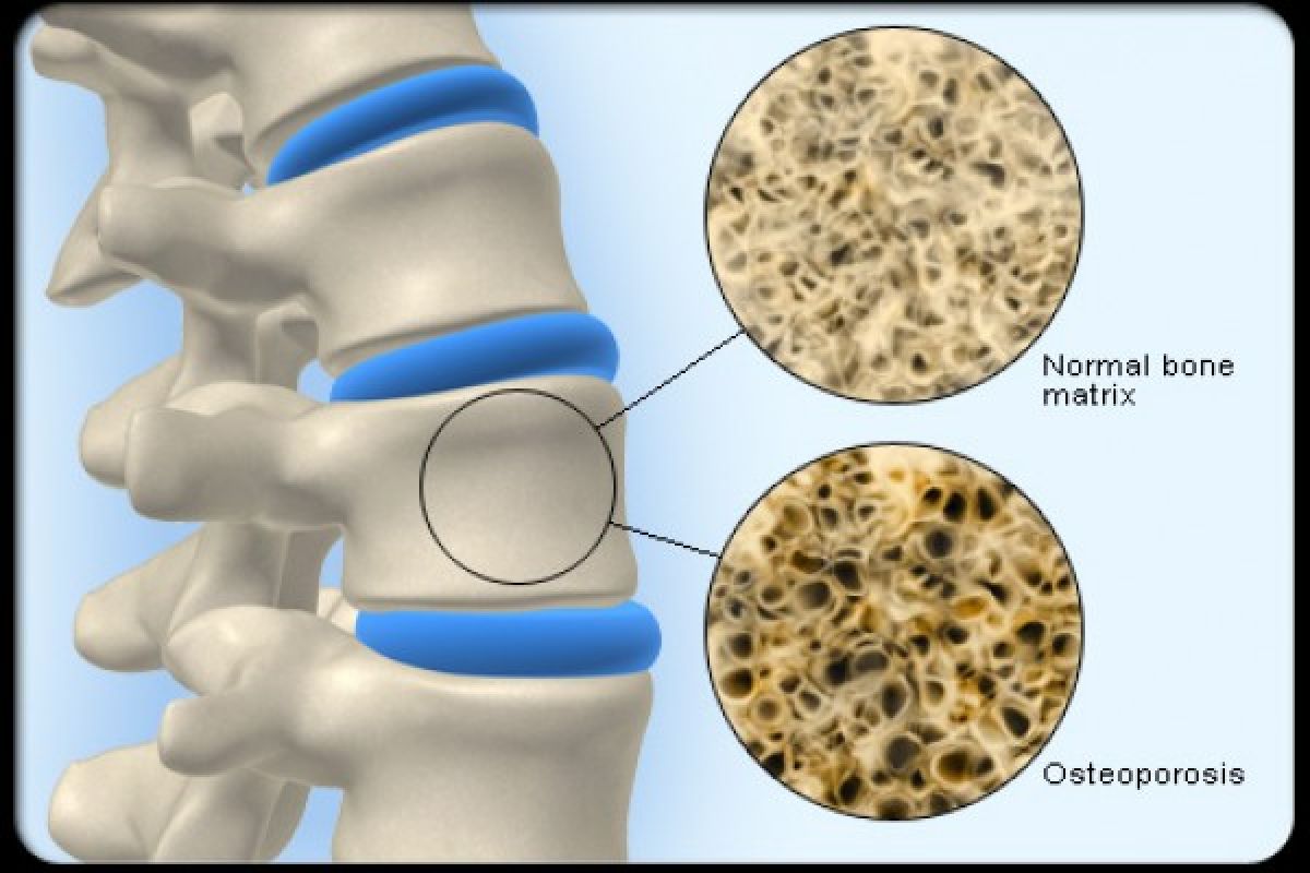 Proses osteoporosis dapat terjadi di usia 30 tahun