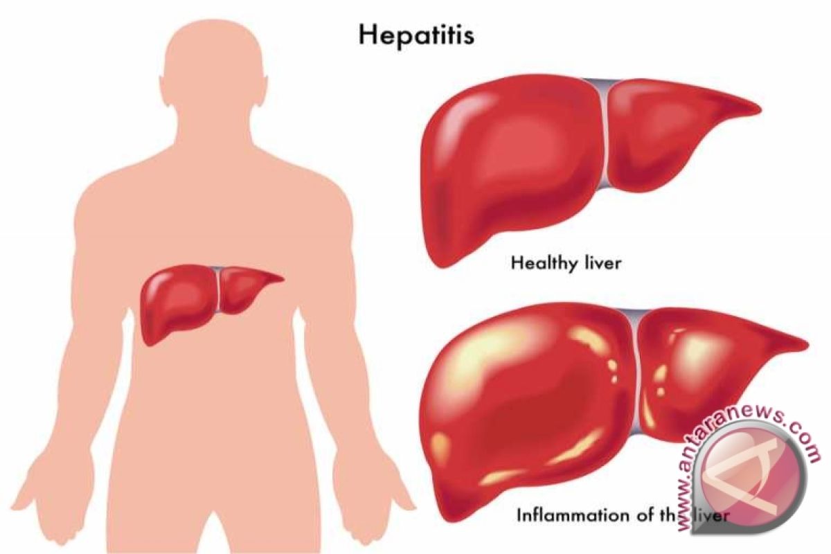 Usia Produktif Diduga Banyak Terjangkit Hepatitis-B