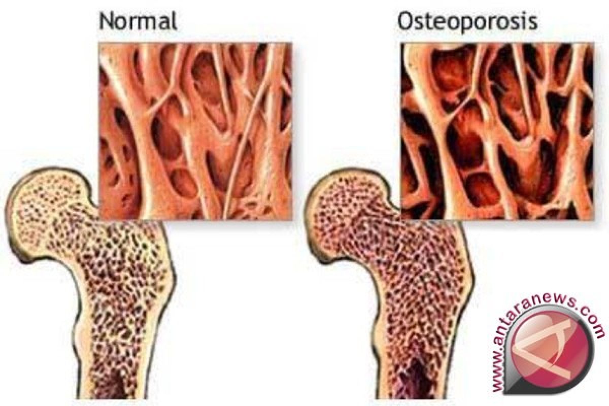 Efek Osteoporosis Tinggi Tubuh Berkurang