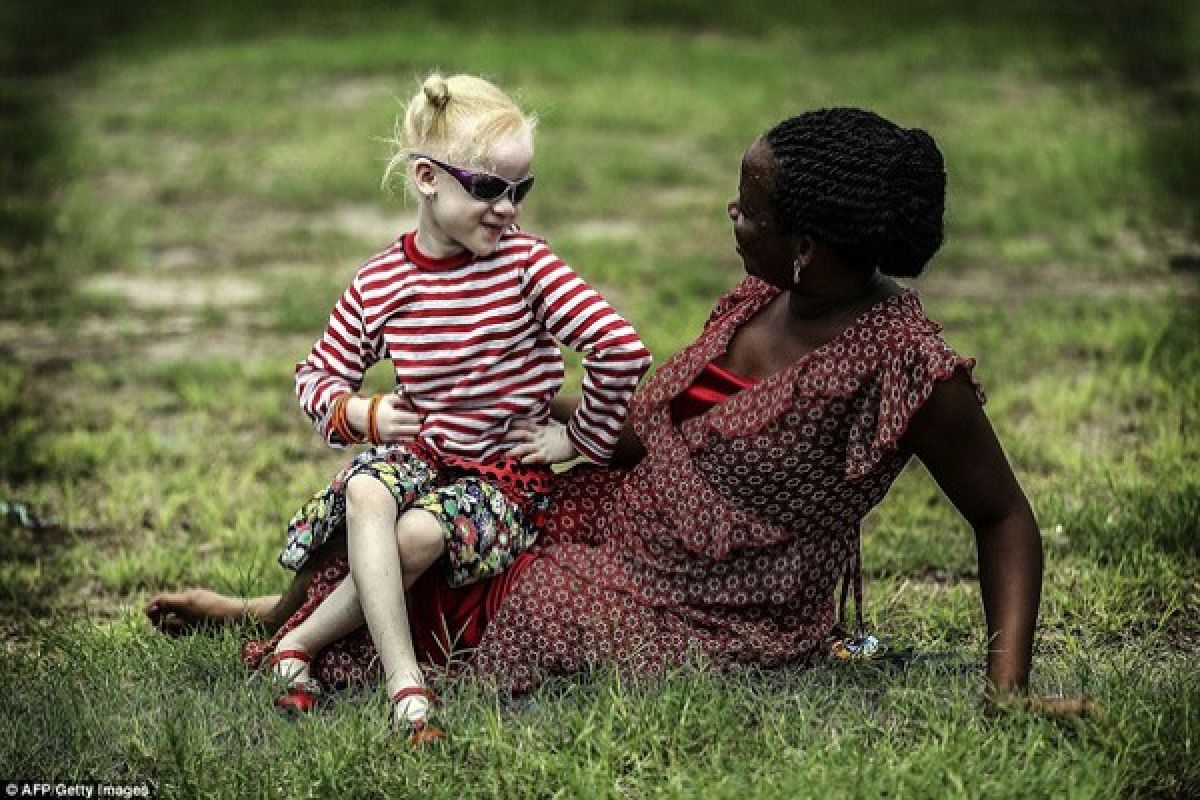 Penderita Albino terancam punah