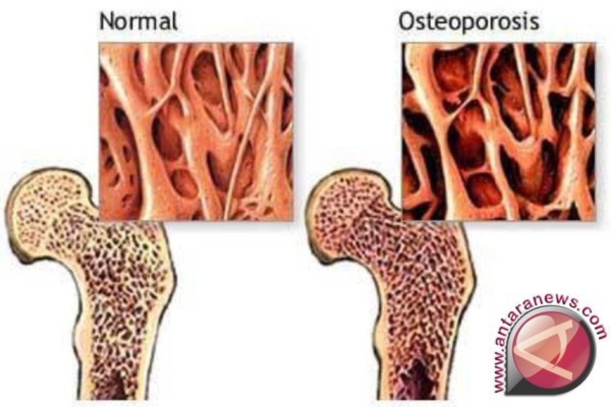 Rutin Bergerak Cegah Osteoporosis