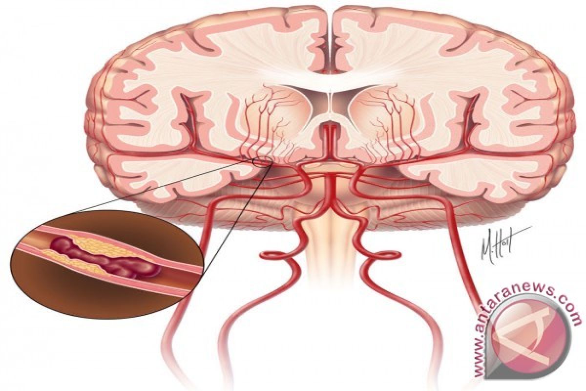 Waspada tubuh lumpuh sesaat mengarah stroke