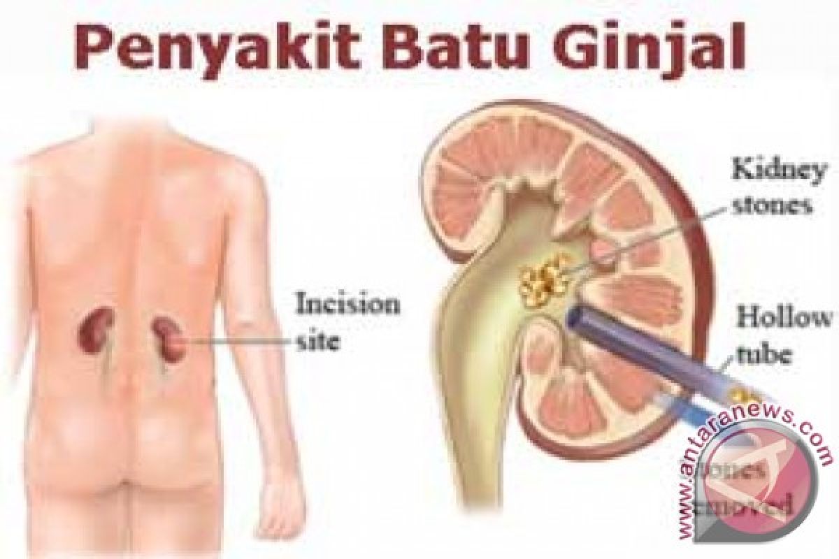 Batu Ginjal Kerap Diderita Pada Usia Produktif