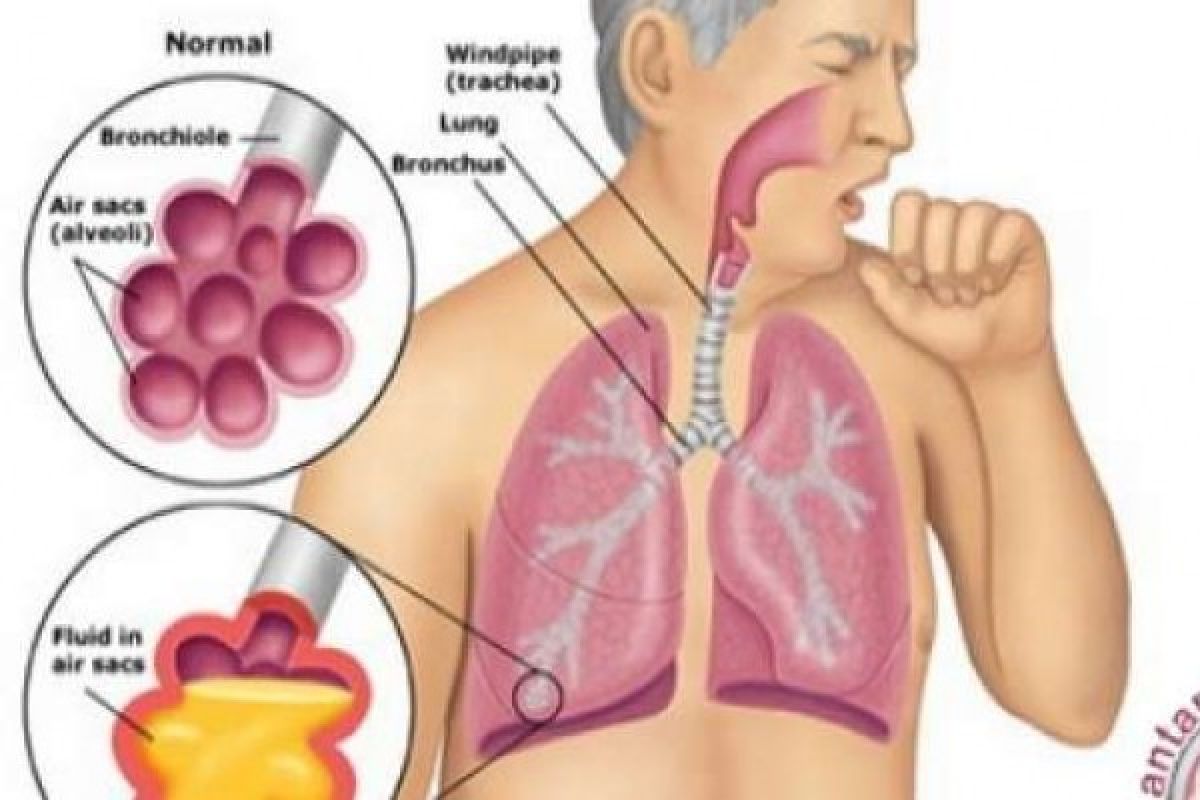 Dinkes Riau Sarankan Terapi DOTS Obati Pasien Tuberkulosis, Ini Penjelasannya