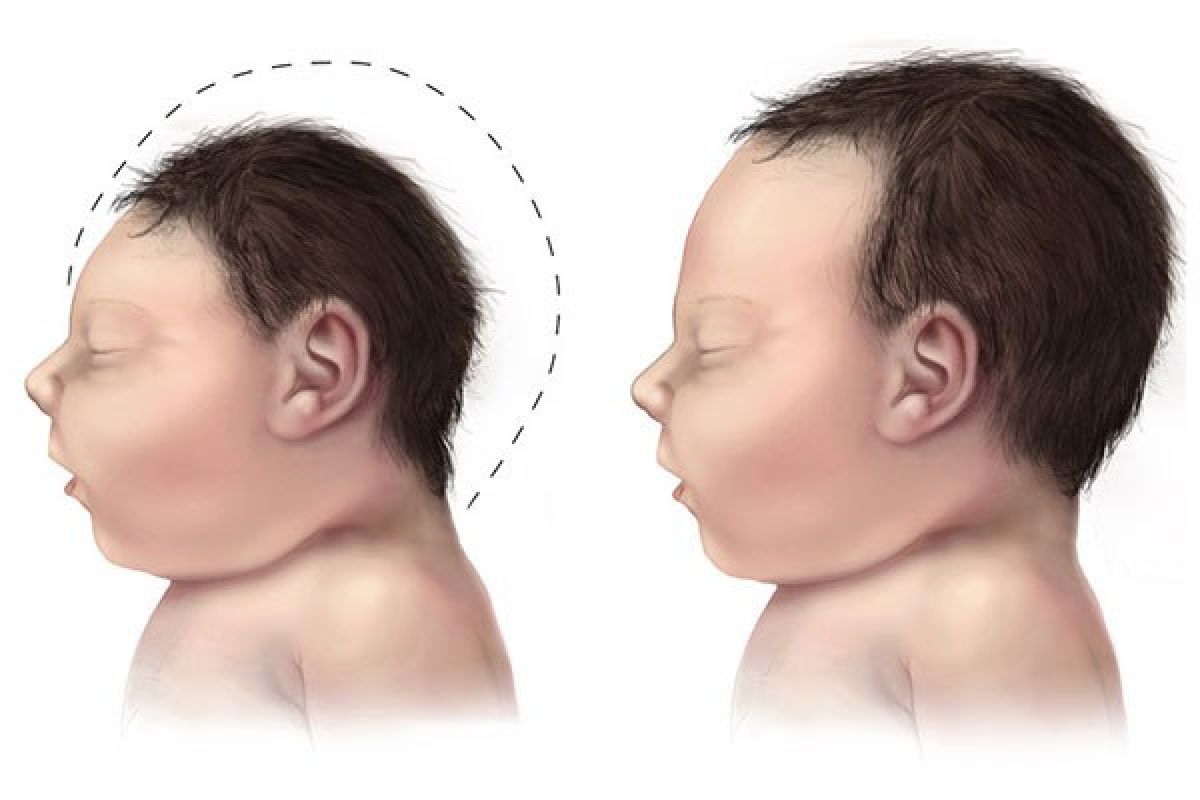 Penelitian: virus zika bisa ditularkan melalui air mata