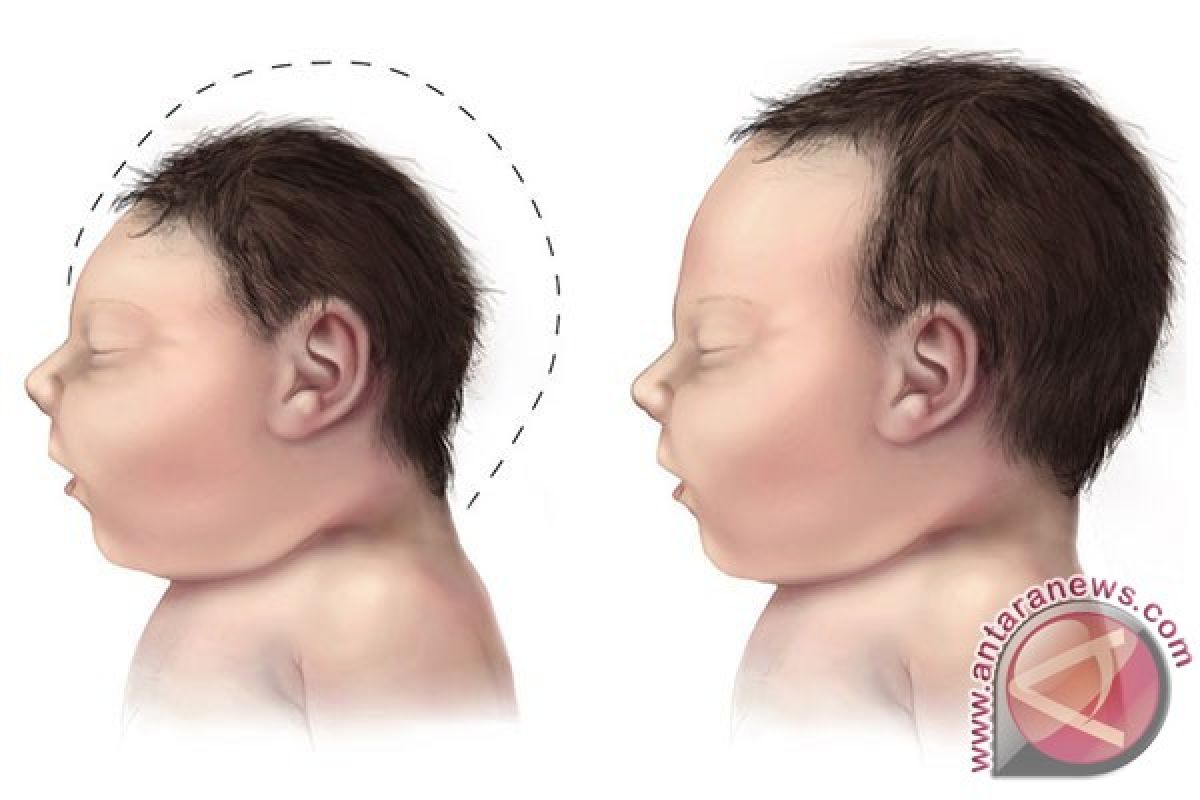 Waduh! Virus Zika Ternyata Bisa Ditularkan Melalui Air Mata