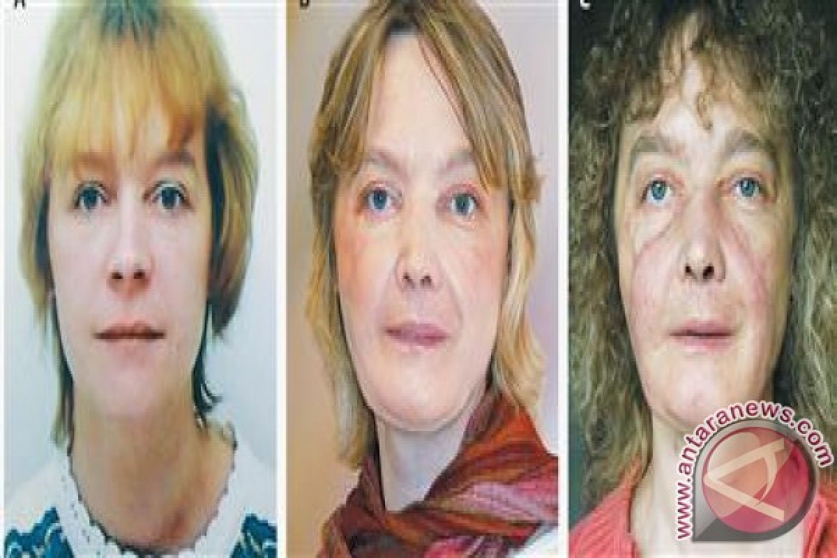 Wanita  penerima transplantasi wajah pertama di dunia meninggal