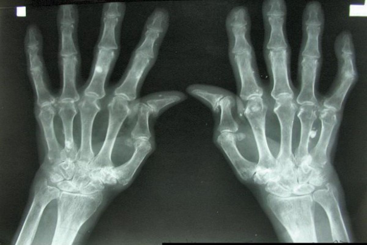 Hobi "kretek" jari? Awas kena artritis