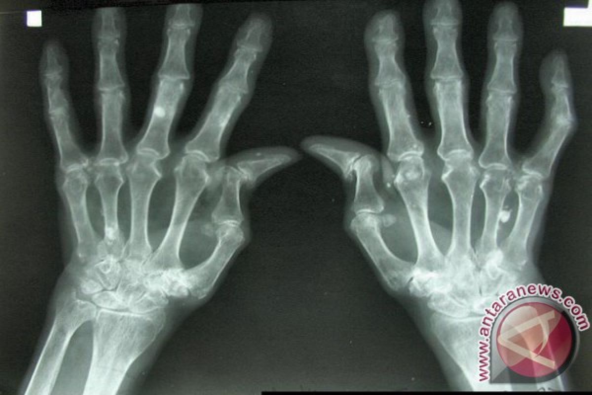 Hobi "kretek" jari? Awas kena artritis