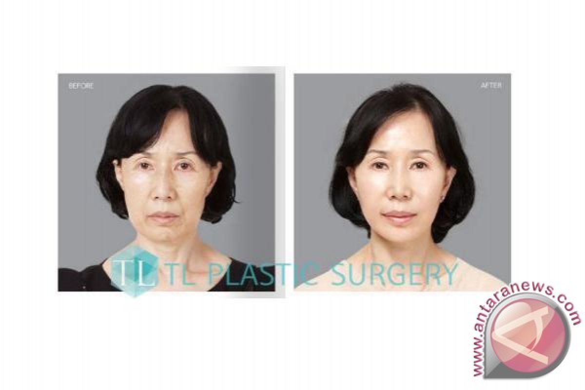 [KOREA TL Plastic Surgery] 'Nothing can replace SMAS Face Lifting!'