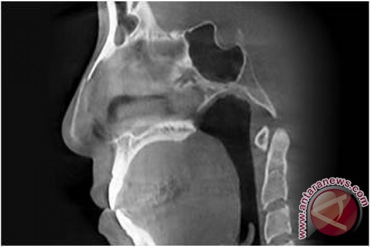 Last chance to fix failed rhinoplasty: 3D procedure â€“ TL Plastic Surgery Korea