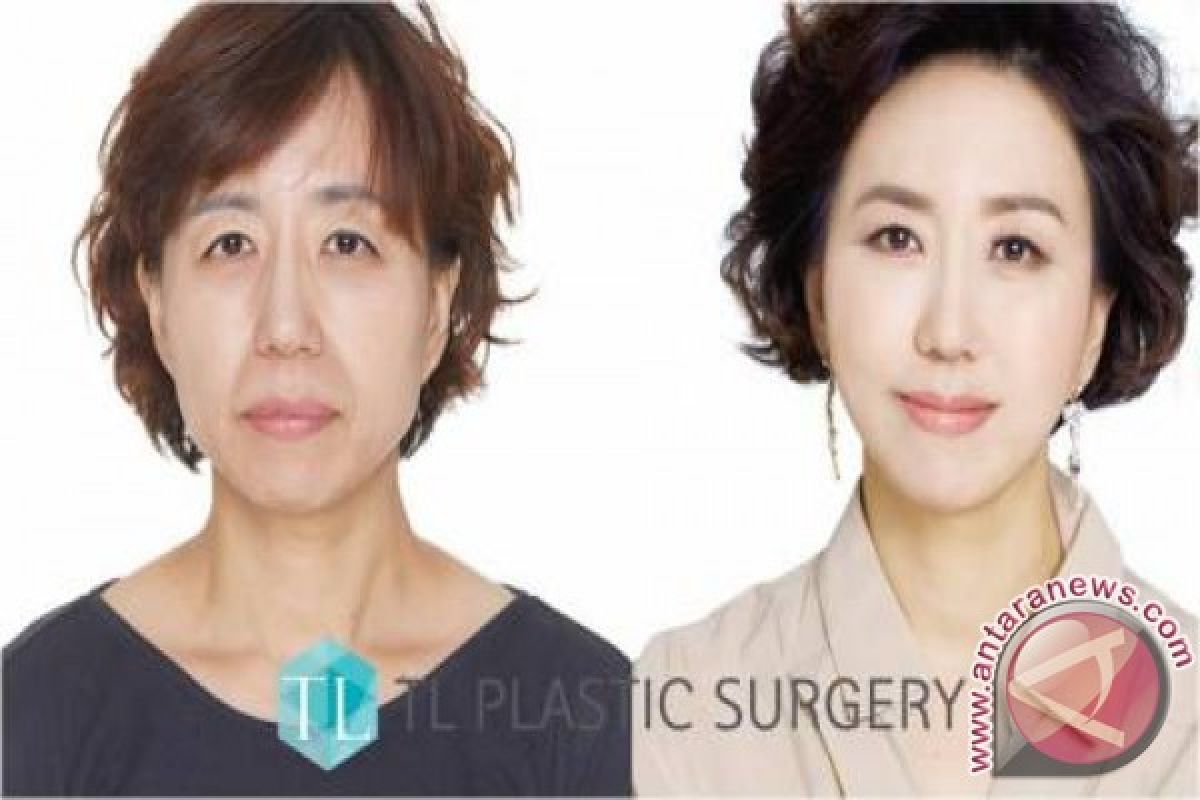 SMAS LIFTING dari TL Plastic Surgery kembalikan kecantikan muda Anda