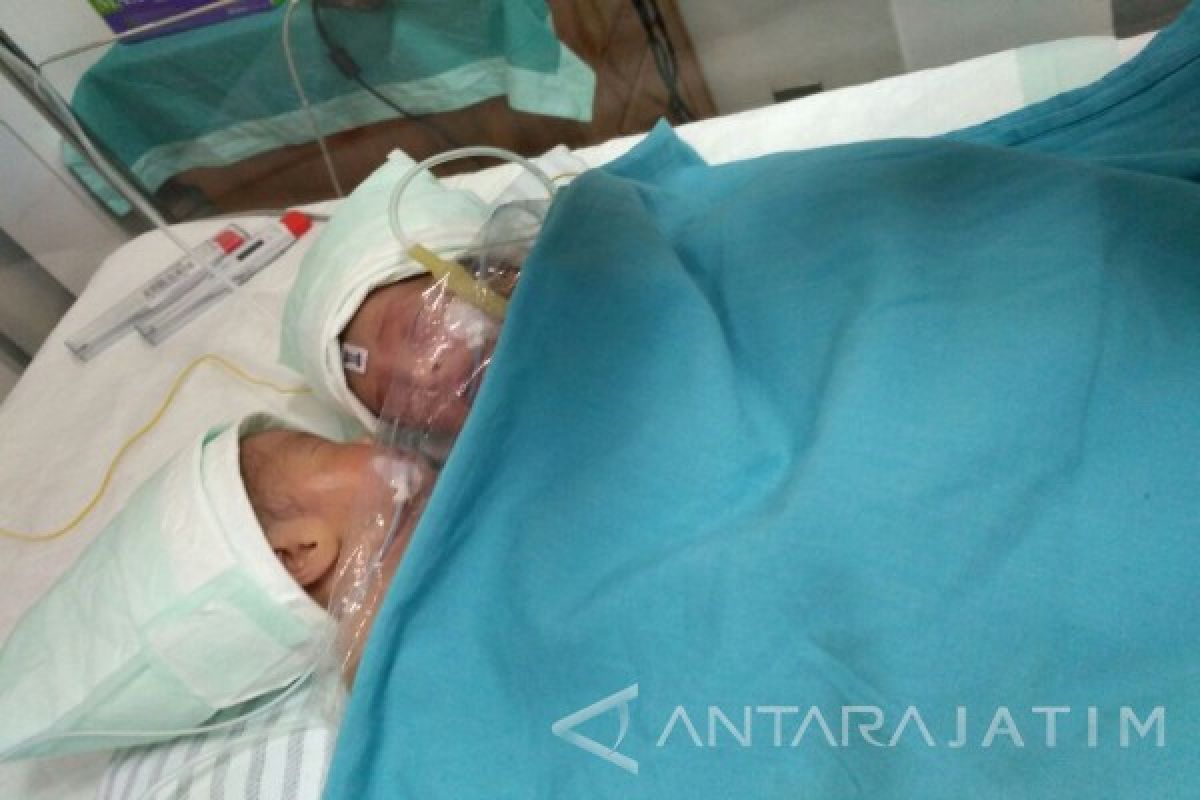 Bayi Pertama Kembar Siam Alami Peradangan Stoma