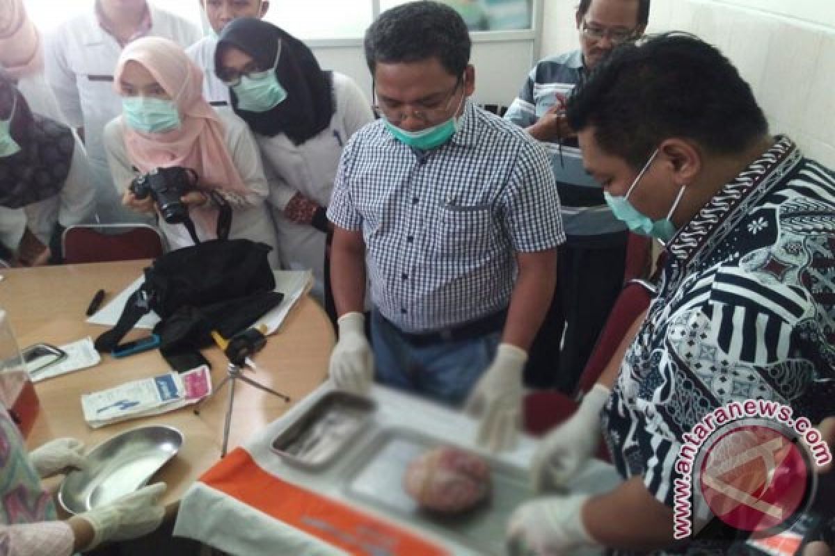 Bayi membatu yang dilahirkan nenek di Jambi akhirnya diawetkan