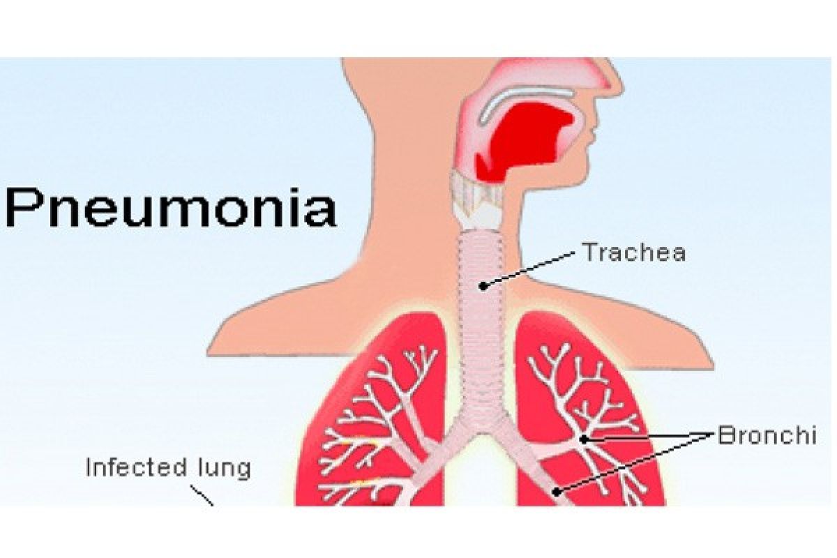 Ministry watchful for mysterious pneumonia infection in Indonesia