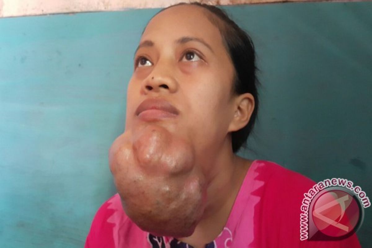 Tumor di Wajah Nurmalasari Makin Membesar