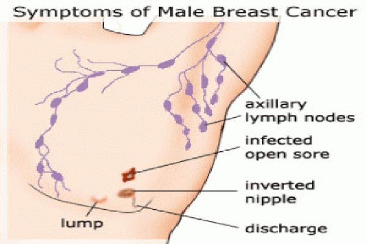 Pria juga berisiko kanker payudara