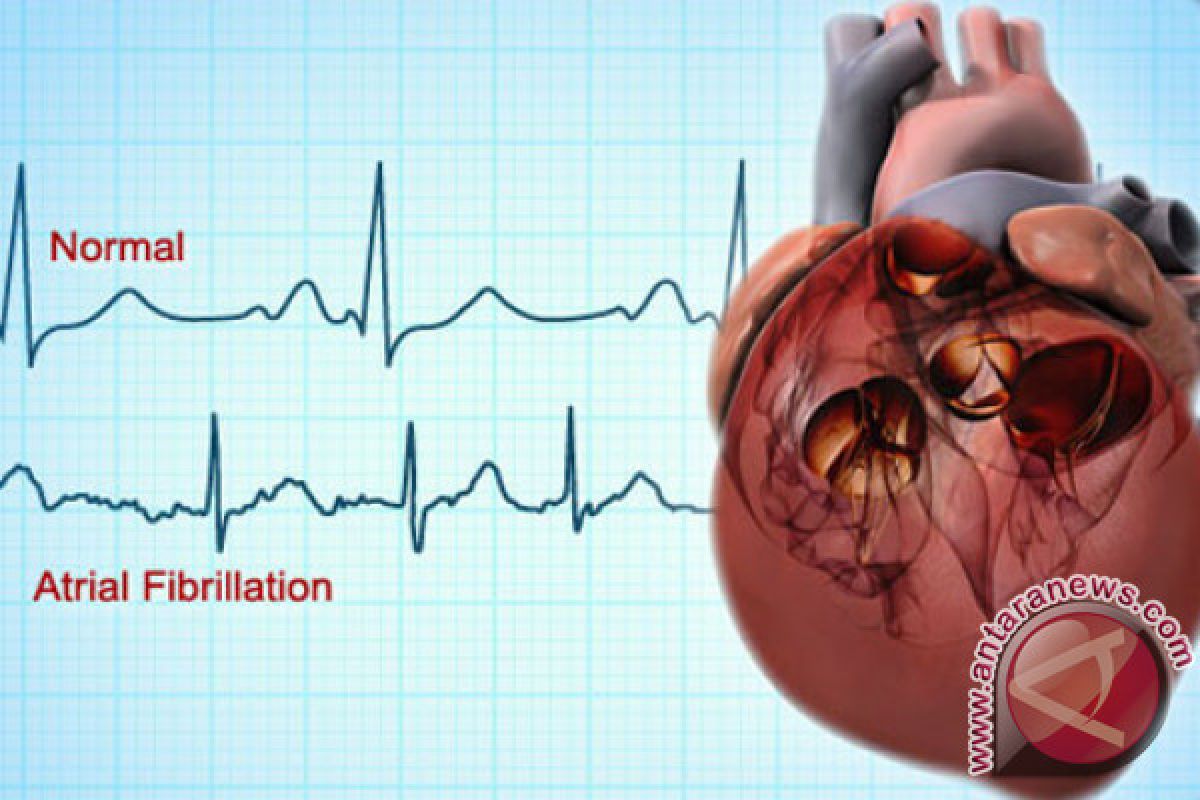 Kelainan Irama Jantung Tingkatkan Risiko Stroke 500 Persen