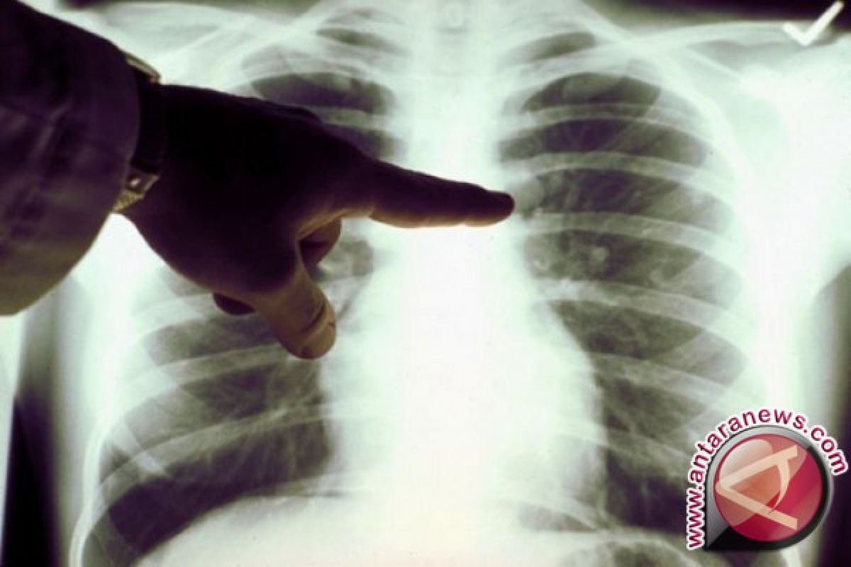 Doktor biomedik UI temukan deteksi dini kanker paru 