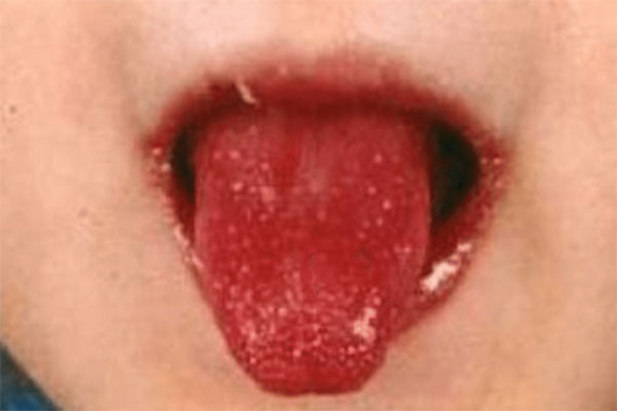 Ciri-ciri kanker lidah yang perlu diwaspadai