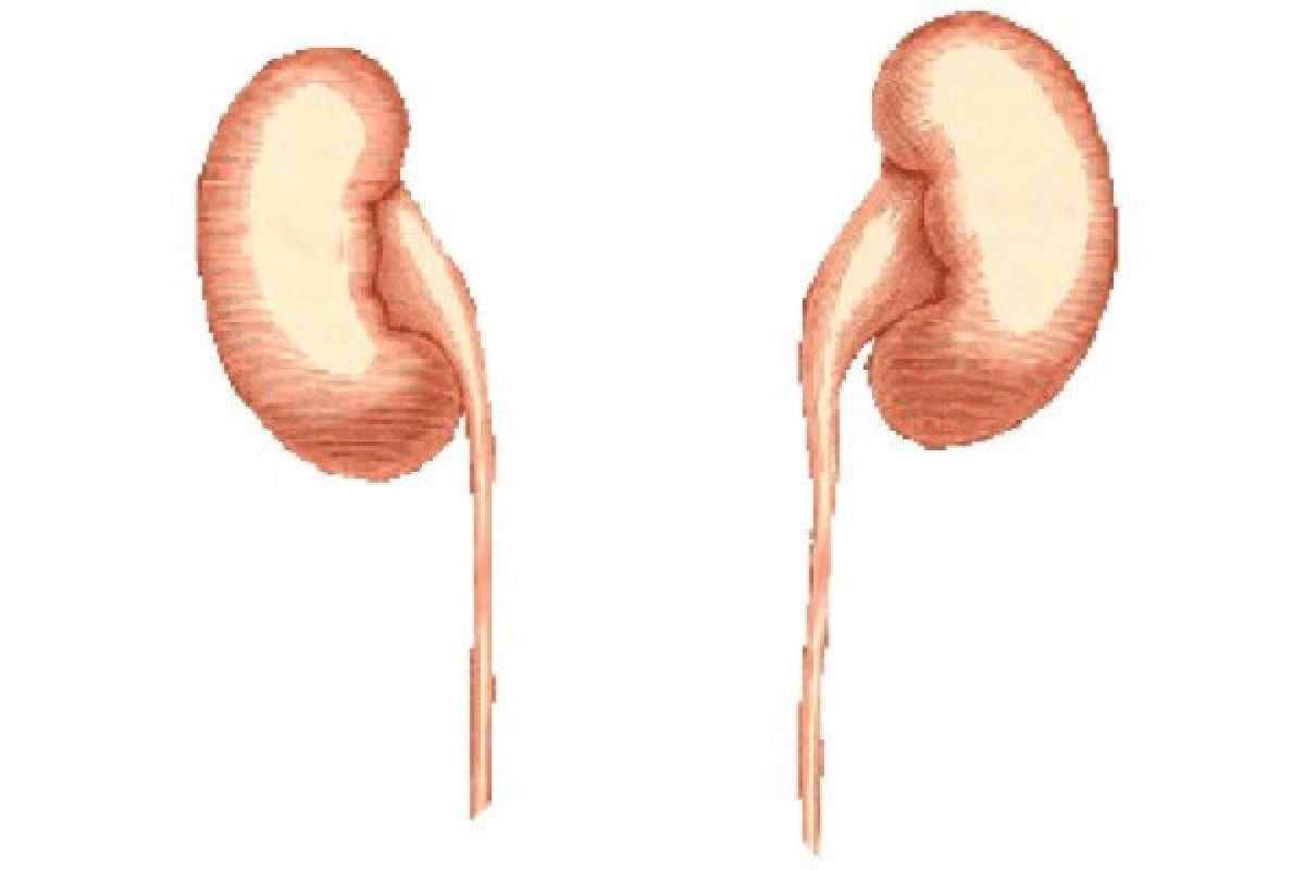 Kenali "staghorn stone" sering tak bergejala