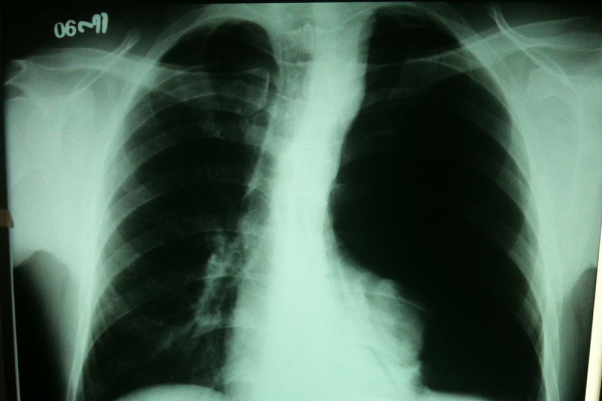 Polusi udara faktor penyebab kanker paru