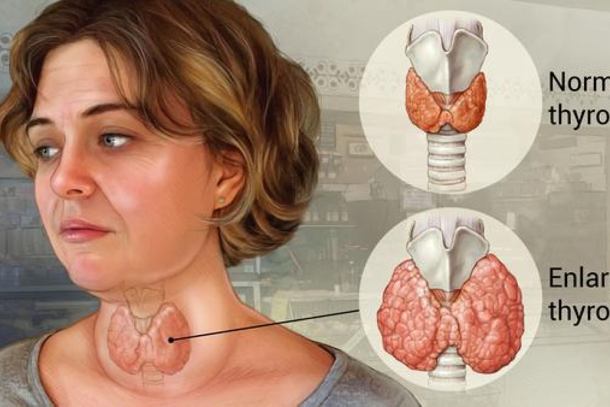 Ambon - Vlissingen jajaki operasi tiroid