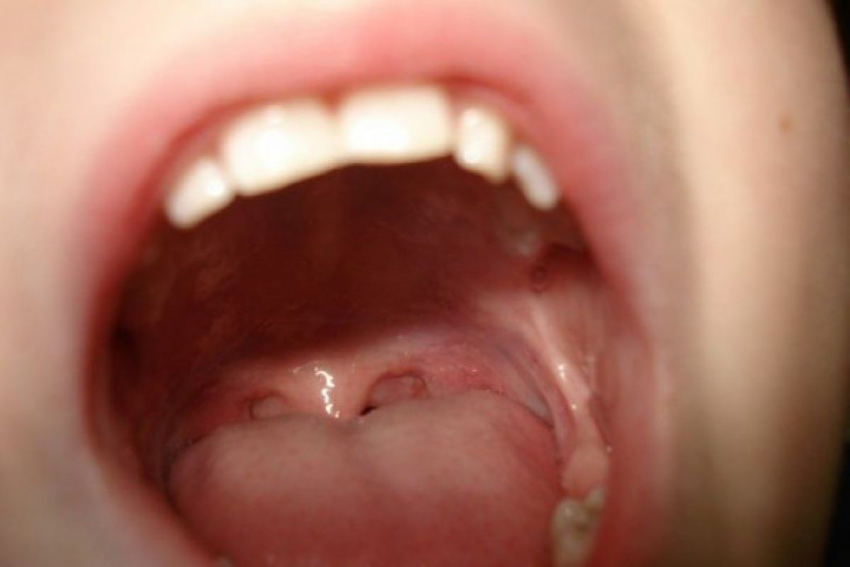 Dokter : Lubang dan karang gigi sebabkan bau mulut