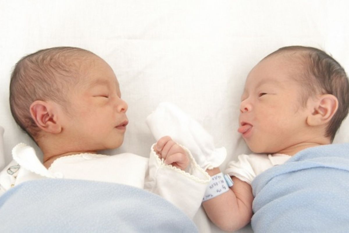 Siamese twins born in Banjarmasin Ulin Hospital