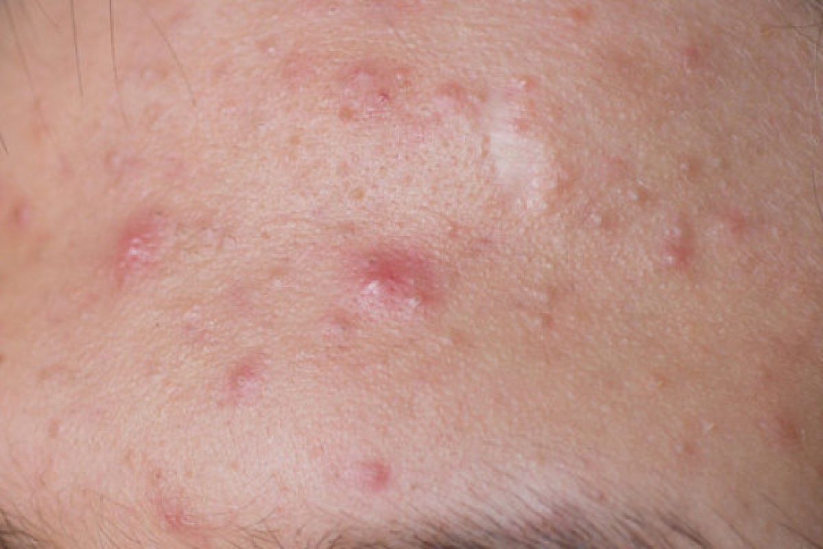 Begadang bisa sebabkan jerawat